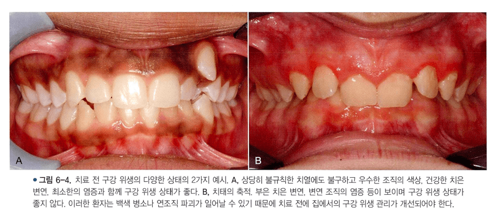 교정 전 구강 위생 상태 비교 — 양호한 경우와 개선이 필요한 경우