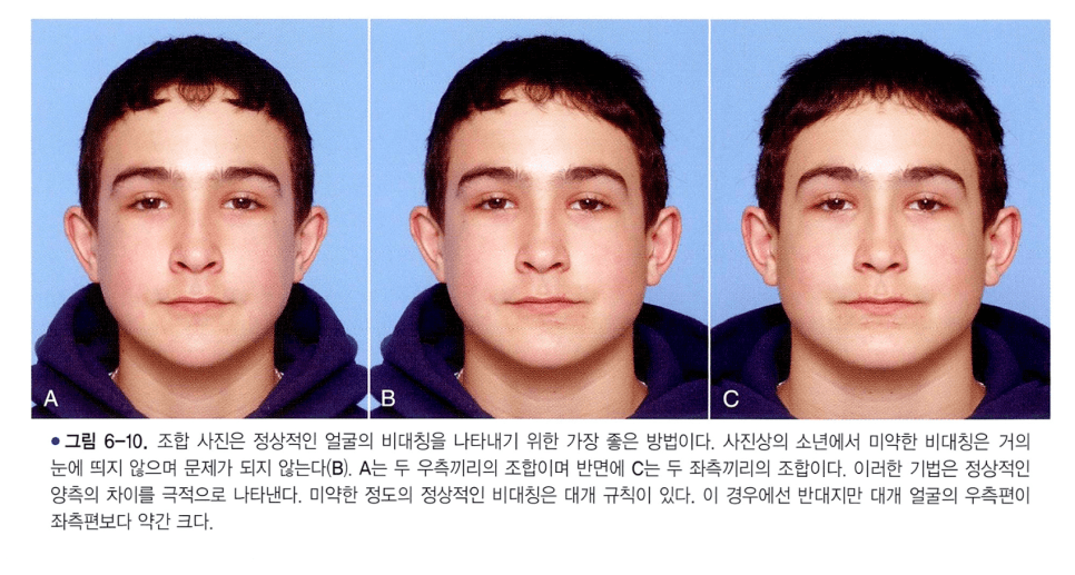 교정 진단에서 사용되는 정면 얼굴 사진 — 비대칭 평가의 기본 자료