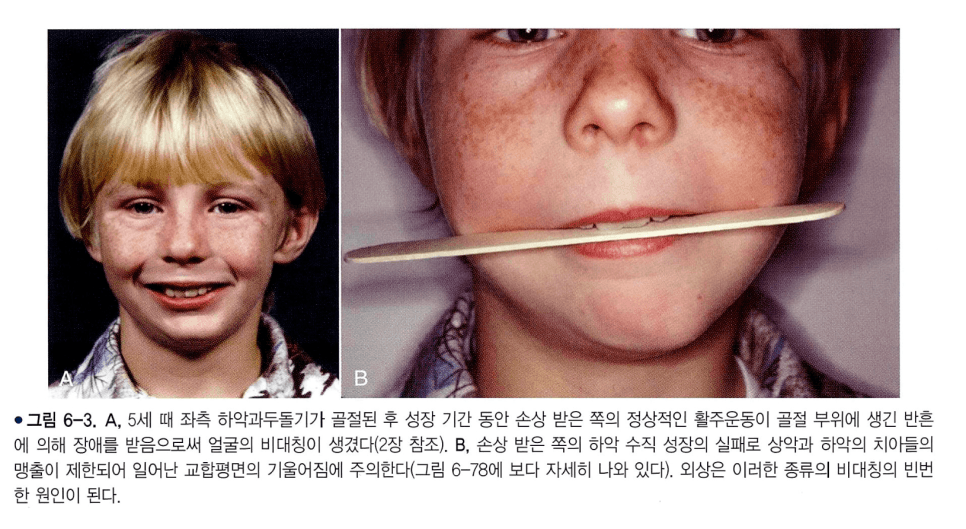 어린 나이의 턱 외상이 성장기 비대칭으로 이어진 사례