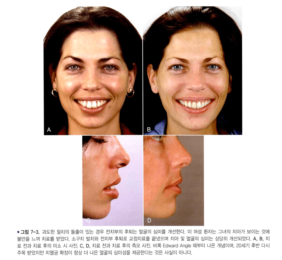 교정치료 전후의 스마일과 측모 변화 — 발치·비발치 선택에 따른 입술과 얼굴 조화