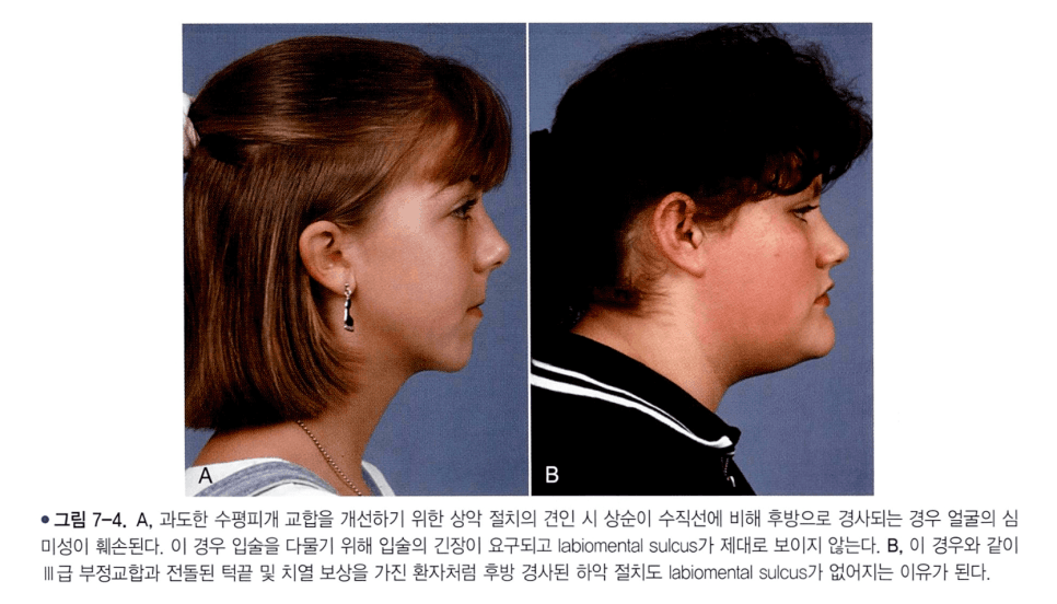 전치를 과도하게 후방 견인했을 때 나타나는 측모 변화