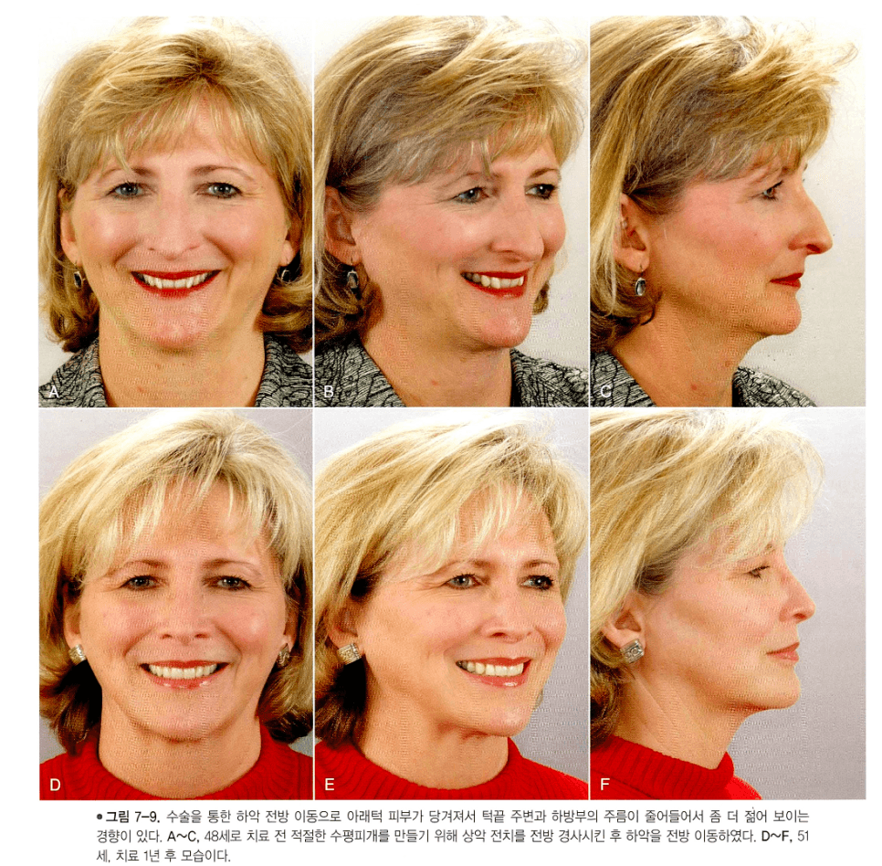 하악 전진 수술 전후 턱 주변 연조직 변화