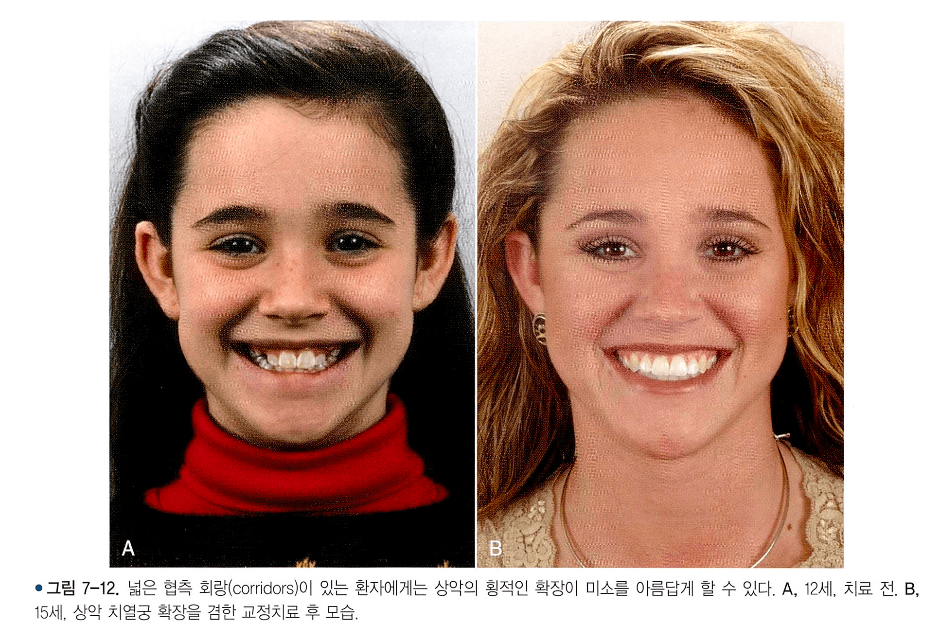 치열궁 확장 전후 미소의 폭 변화