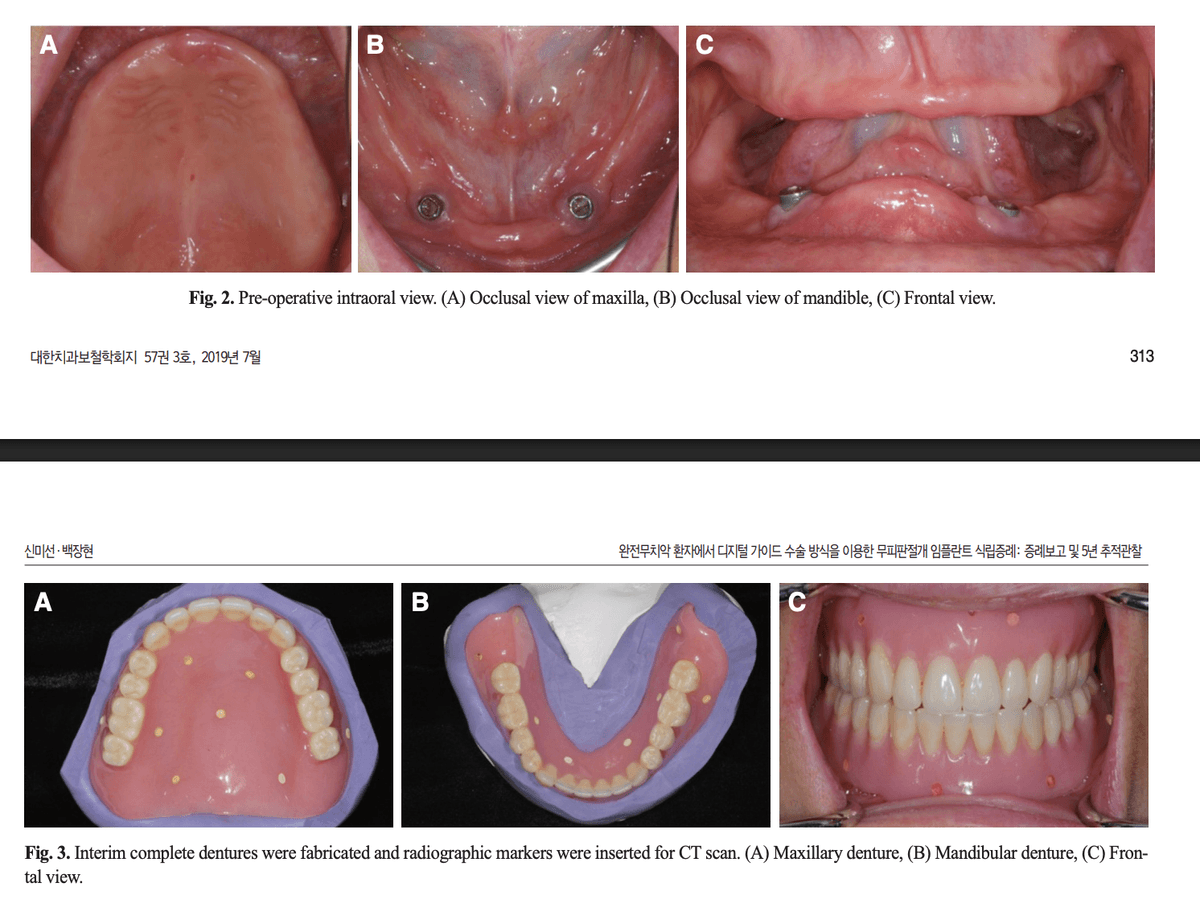 수술 전 구강 내 사진과 방사선 마커가 삽입된 임시 총의치
