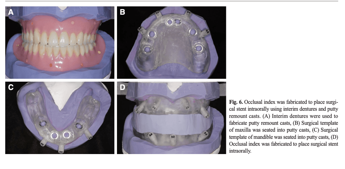임시 총의치와 퍼티 모형으로 제작한 교합 인덱스 — 수술용 스텐트를 구강 내 정확한 위치에 고정