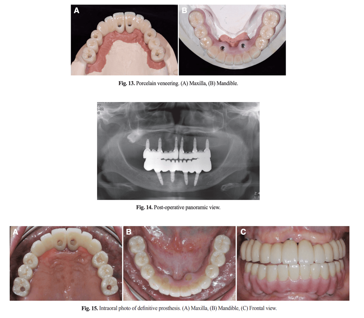전치부 도재 축성, 장착 후 파노라마, 최종 보철물 구강 내 사진