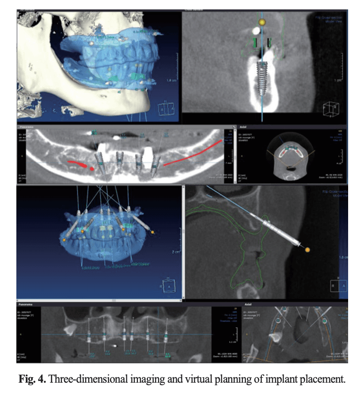 3차원 영상과 소프트웨어 상의 임플란트 가상 식립 계획