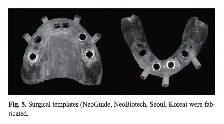3D 프린팅으로 제작된 상·하악 수술용 스텐트(NeoGuide)