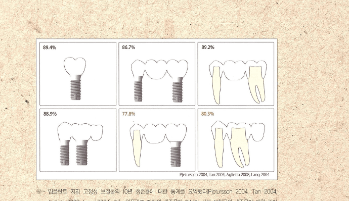 임플란트 지지 보철과 자연치 지지 보철의 10년 생존율 비교