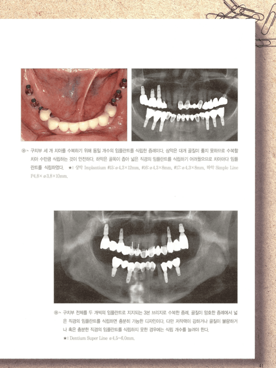구치부 임플란트 식립 임상 증례 — 구강 내 사진과 파노라마 방사선 사진