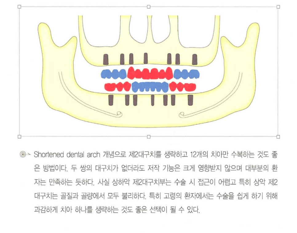 단축 치열궁 개념 적용 — 제2대구치를 생략하고 12개 치아를 수복하는 상·하악 설계