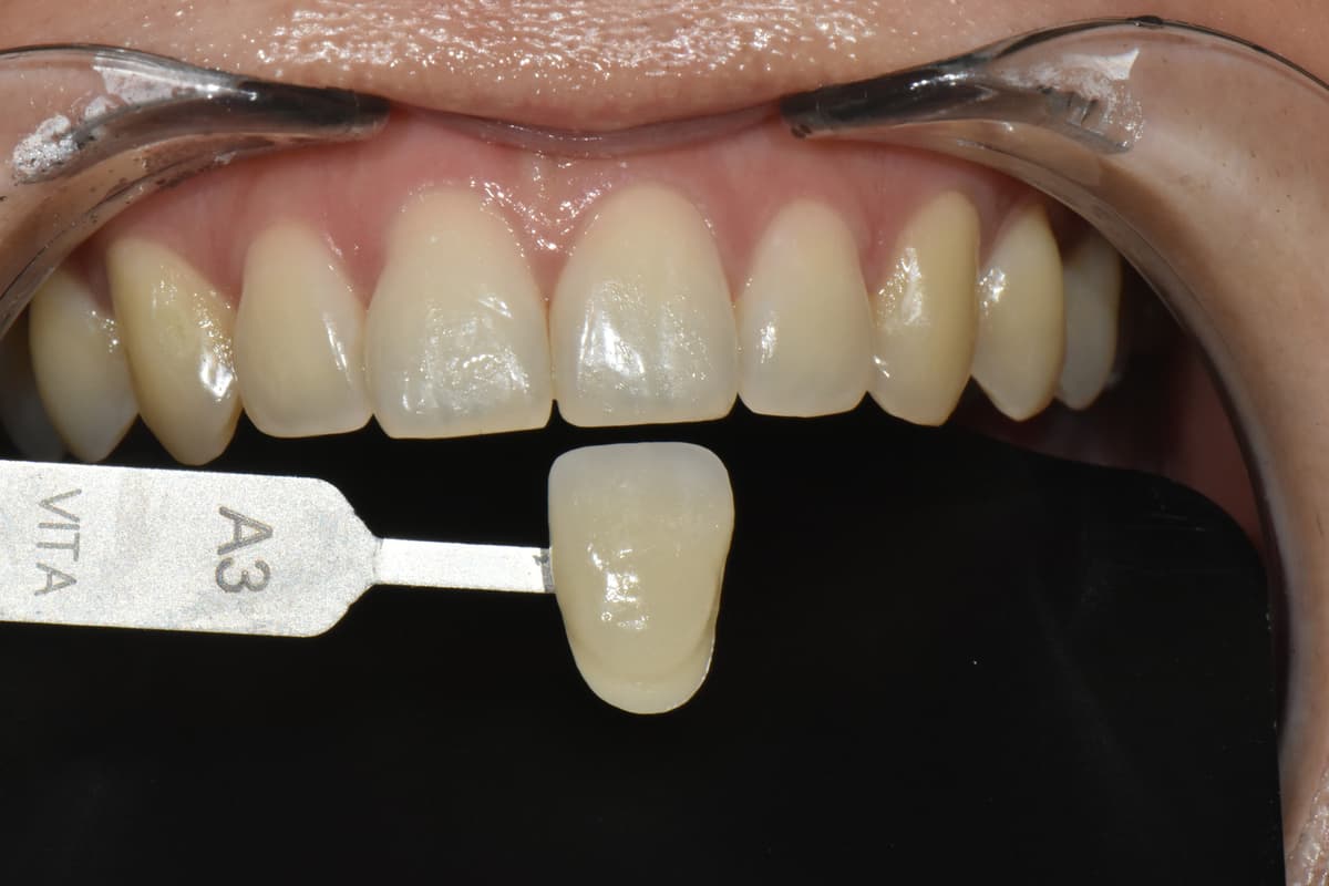 ก่อนฟอกสีฟัน