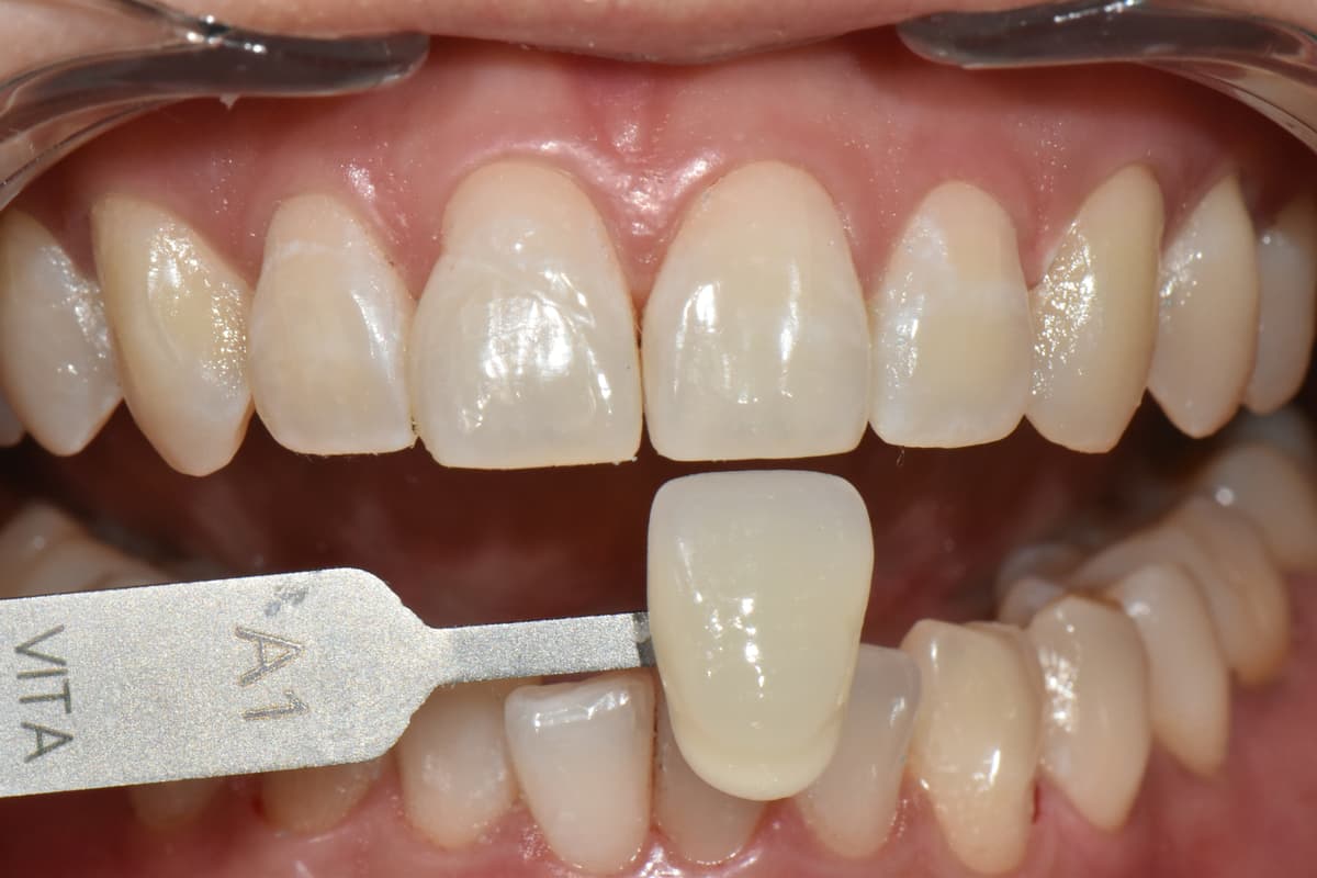 หลังฟอกสีฟัน