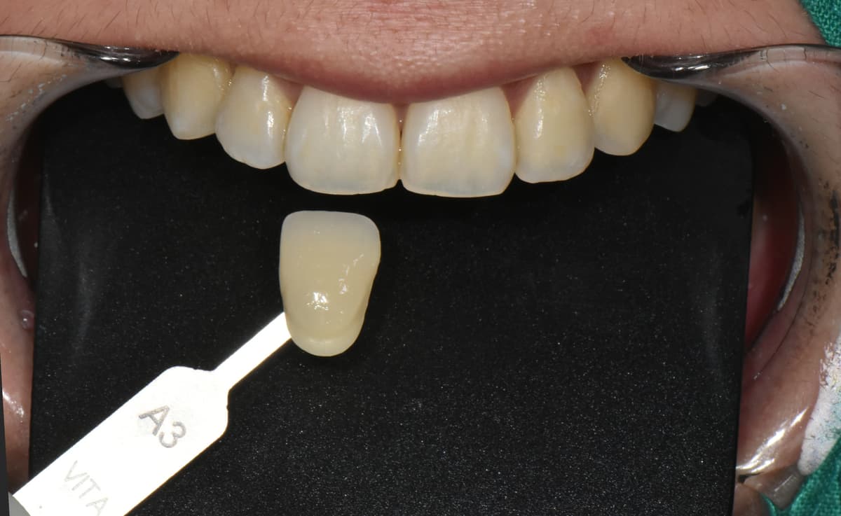 ก่อนฟอกสีฟัน