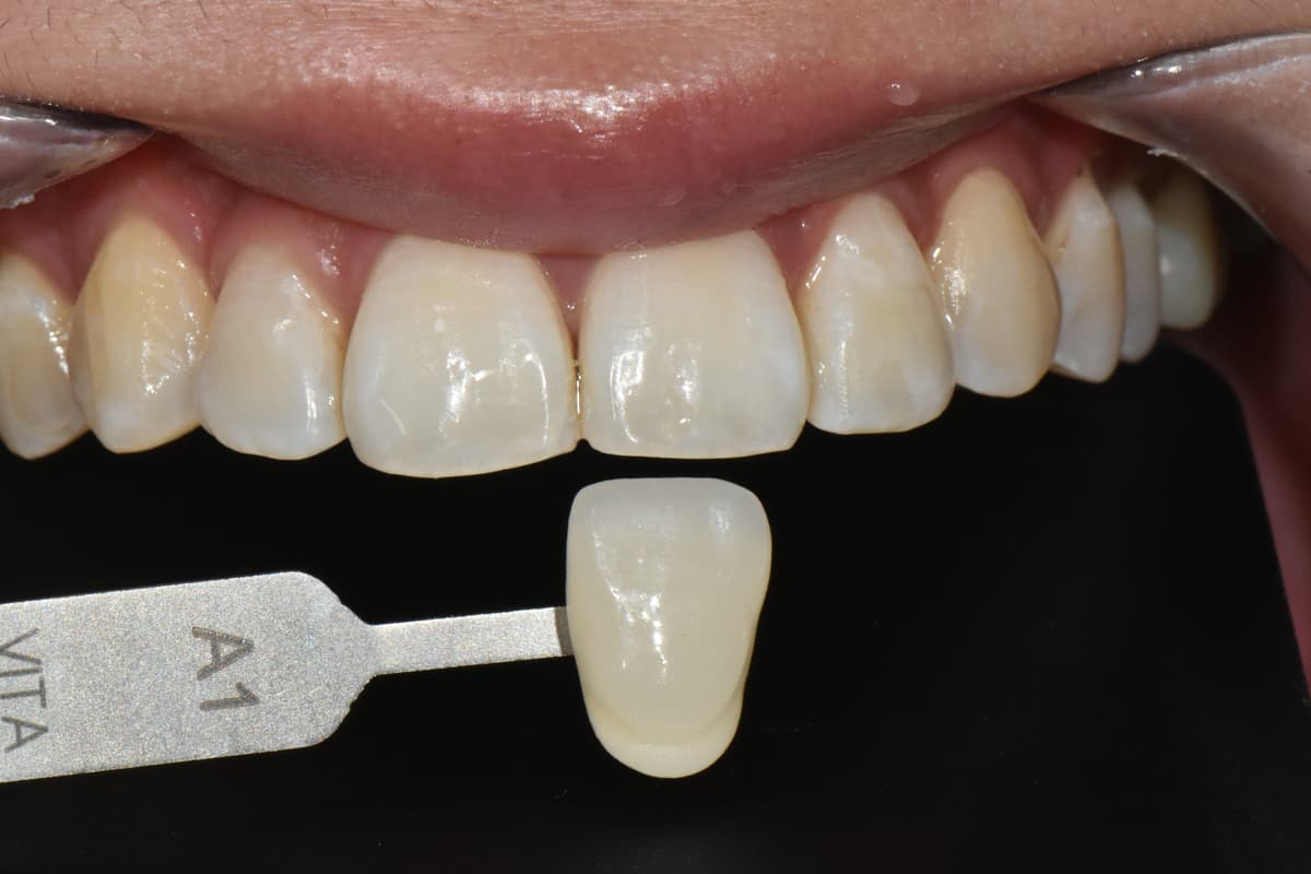 หลังฟอกสีฟัน