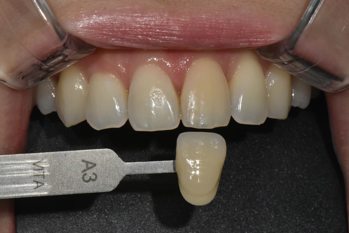 ก่อนฟอกสีฟัน