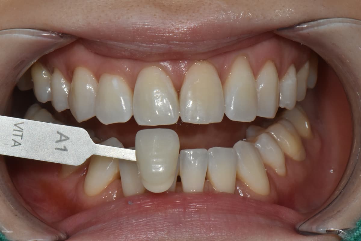 หลังฟอกสีฟัน