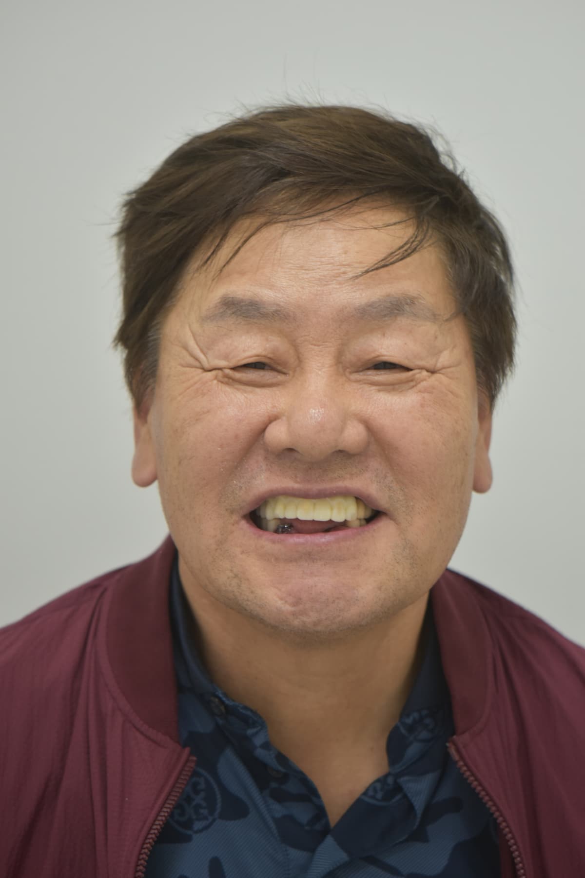 Bir kunlik vaqtincha tishdan keyin