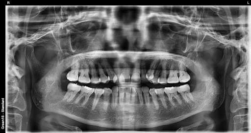 To'liq ko'milgan aql tishi - sug'urishdan keyin