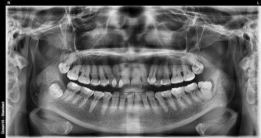 To'liq ko'milgan aql tishi - sug'urishdan oldin