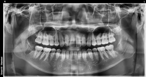 Oddiy aql tishi - sug'urishdan keyin