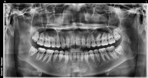 Oddiy aql tishi - sug'urishdan oldin