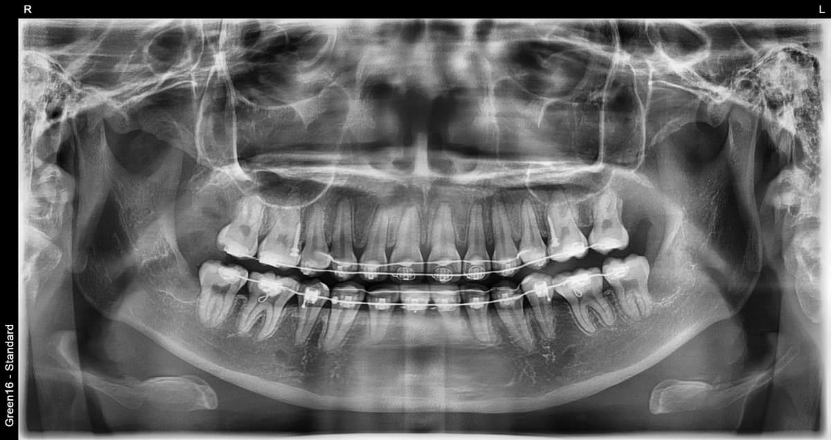 Ortodontiya davrida aql tishi - sug'urishdan keyin