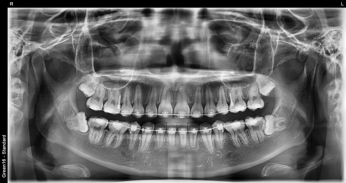 Ortodontiya davrida aql tishi - sug'urishdan oldin