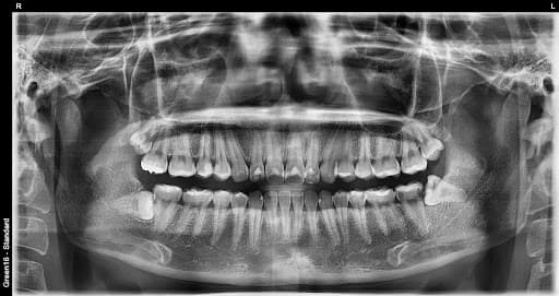 Qisman ko'milgan aql tishi - sug'urishdan oldin