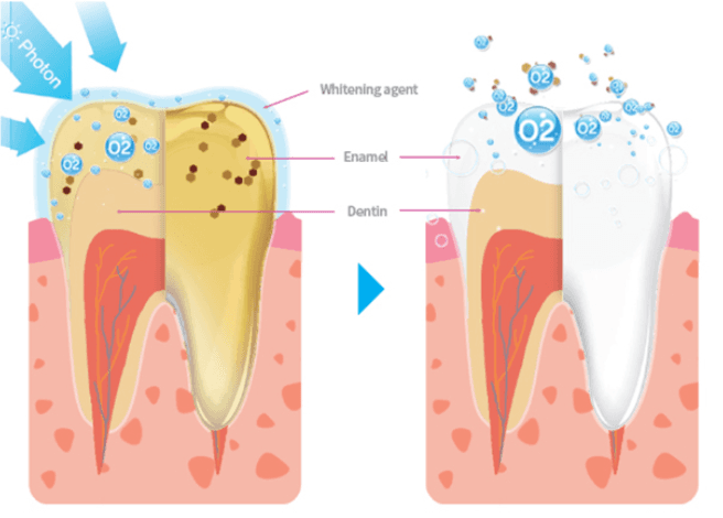 หลักการฟอกสีฟันด้วยไฮโดรเจนเปอร์ออกไซด์