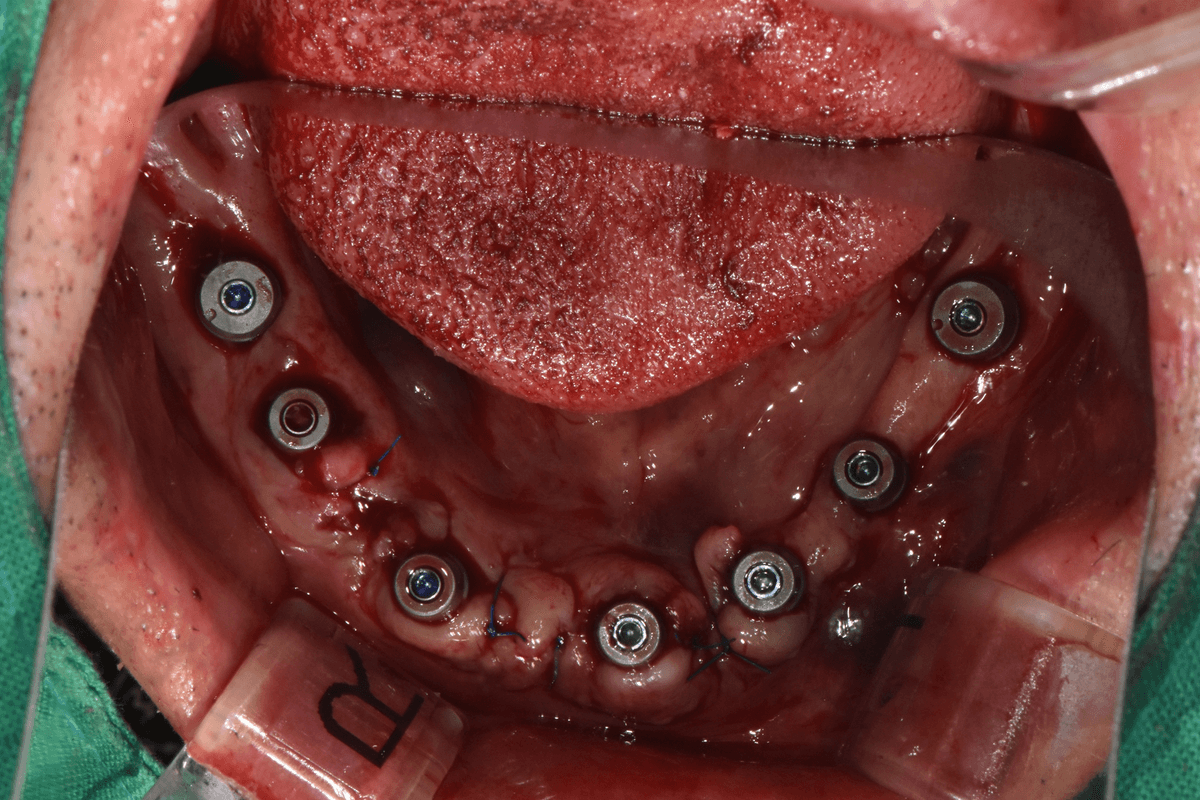 Phẫu thuật Implant không lật vạt
