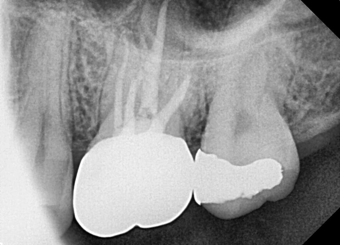 치료 1년 9개월 후